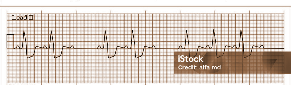 Eletrocardiograma em derivação II com ondas P regulares e complexos QRS intermitentes
