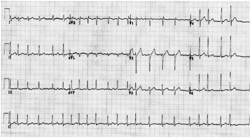 Eletrocardiograma de 12 derivações do caso clínico 10A1-II