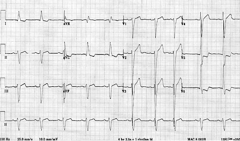 Eletrocardiograma de 12 derivações da paciente de 84 anos