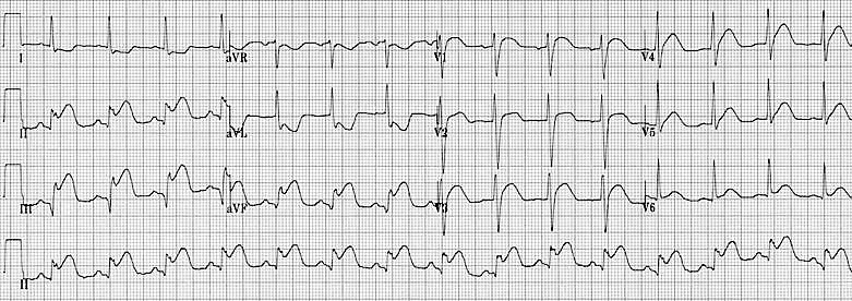 Eletrocardiograma de 12 derivações da paciente de 70 anos com dor torácica lancinante