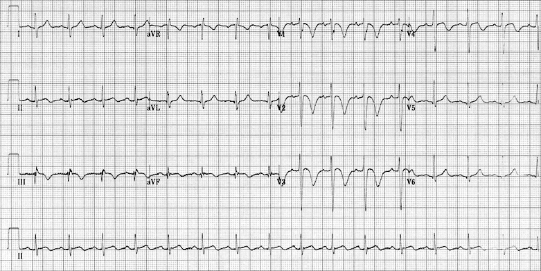 Eletrocardiograma de 12 derivações do paciente de 70 anos com dor torácica súbita e síncope