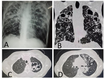 Imagens radiológicas de tuberculose pulmonar