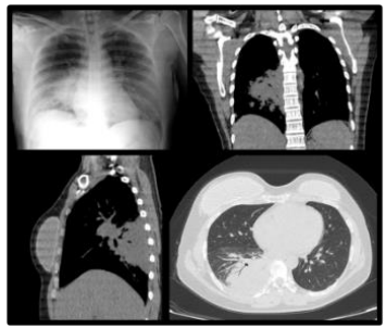 Radiografia e tomografia de tórax