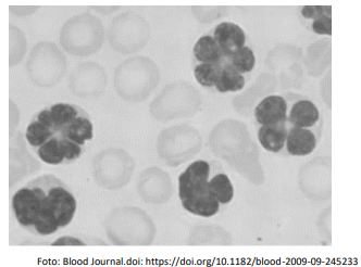 Células atípicas em sangue periférico