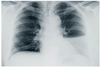 Telerradiografia de tórax com derrame pleural